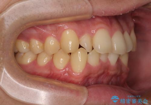 前歯のデコボコを治したい ワイヤー装置での非抜歯矯正の治療前