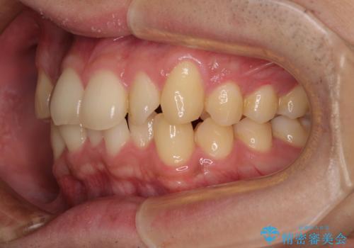 前歯のデコボコを治したい ワイヤー装置での非抜歯矯正の治療前