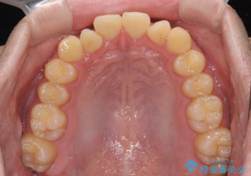 前歯のデコボコを治したい ワイヤー装置での非抜歯矯正の治療前