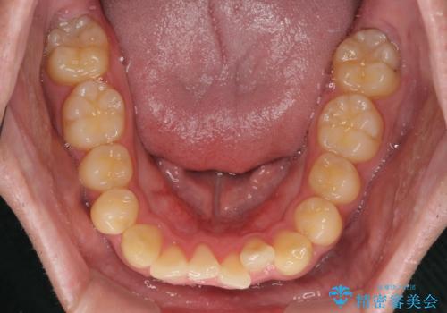 前歯のデコボコを治したい ワイヤー装置での非抜歯矯正の治療前