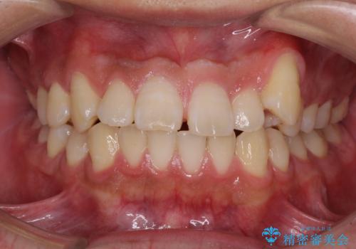 目立つ八重歯を非抜歯矯正で整える 目立たないワイヤー矯正の症例 治療前