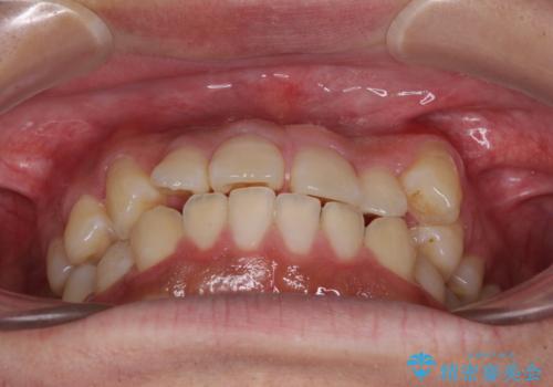 目立つ八重歯を非抜歯矯正で整える 目立たないワイヤー矯正の治療前