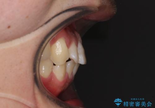 目立つ八重歯を非抜歯矯正で整える 目立たないワイヤー矯正の治療前