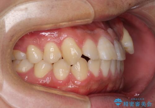 目立つ八重歯を非抜歯矯正で整える 目立たないワイヤー矯正の治療前