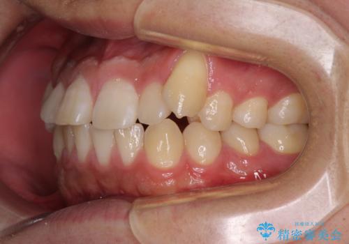 目立つ八重歯を非抜歯矯正で整える 目立たないワイヤー矯正の治療前