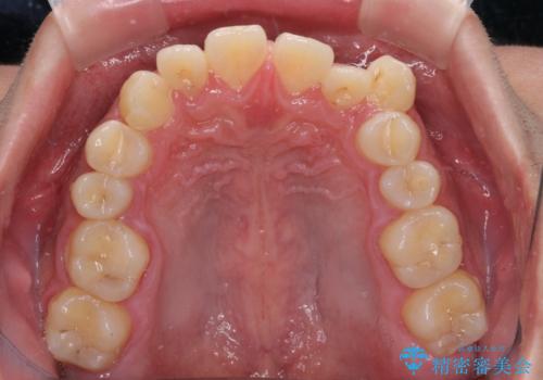 目立つ八重歯を非抜歯矯正で整える 目立たないワイヤー矯正の治療前