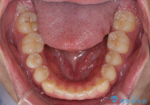 目立つ八重歯を非抜歯矯正で整える 目立たないワイヤー矯正の治療前