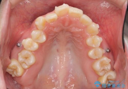 サクソフォン(アルト)の演奏で崩れてしまった歯並び、マウスピース矯正治療の治療前