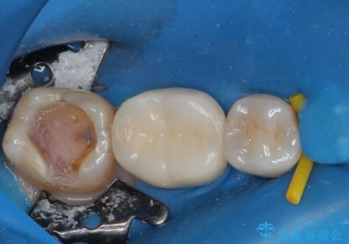 銀歯をやり替えたい フルジルコニアクラウン・セラミックインレー修復の治療中