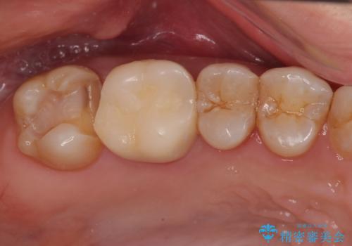 銀歯をやり替えたい フルジルコニアクラウン・ゴールドインレー修復の治療中