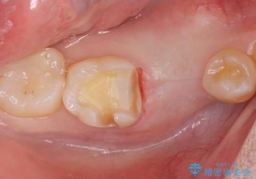 インプラント治療の治療中