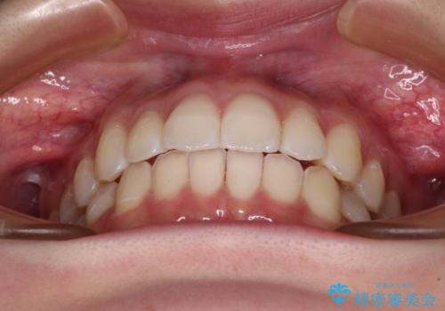 【モニター】前に傾斜した前歯 インビザラインでスッキリとした口元にの治療中