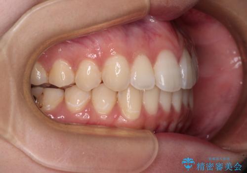 【モニター】前に傾斜した前歯 インビザラインでスッキリとした口元にの治療中
