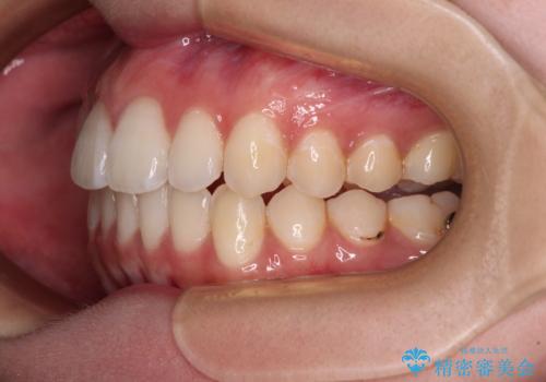【モニター】前に傾斜した前歯 インビザラインでスッキリとした口元にの治療中