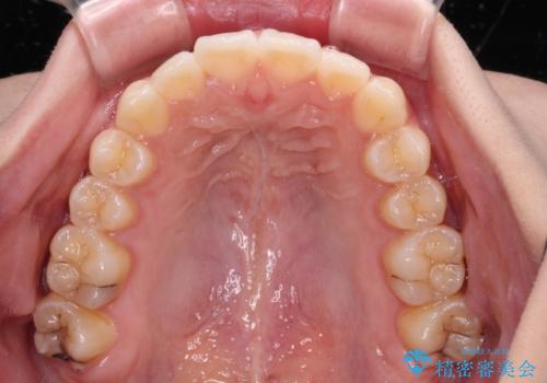 【モニター】前に傾斜した前歯 インビザラインでスッキリとした口元にの治療中