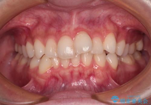 前歯のデコボコを治したい 目立たないワイヤー装置での矯正治療の症例 治療前