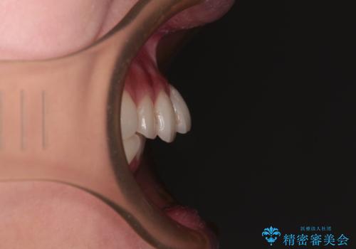 前歯のデコボコを治したい 目立たないワイヤー装置での矯正治療の治療前