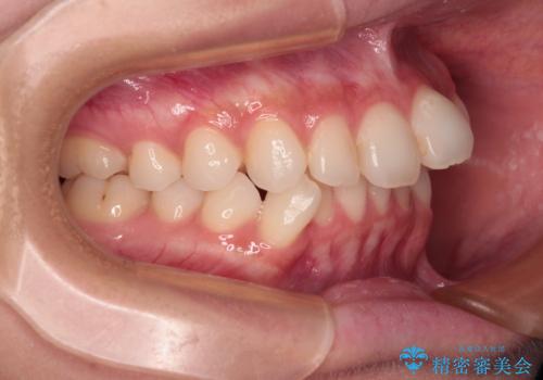 前歯のデコボコを治したい 目立たないワイヤー装置での矯正治療の治療前