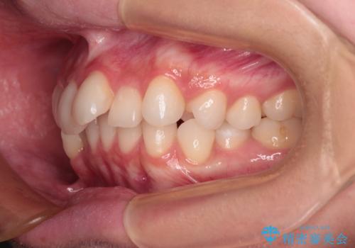 前歯のデコボコを治したい 目立たないワイヤー装置での矯正治療の治療前