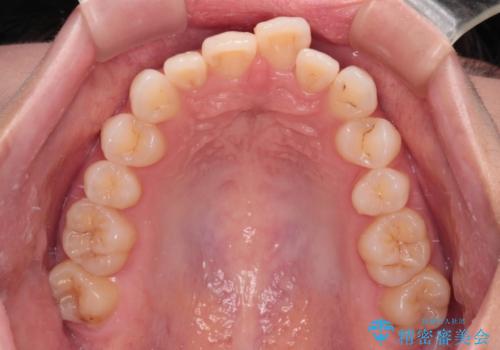 前歯のデコボコを治したい 目立たないワイヤー装置での矯正治療の治療前