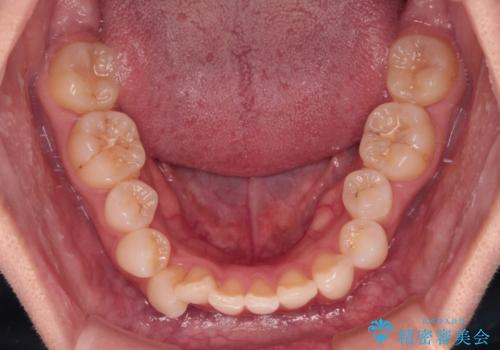 前歯のデコボコを治したい 目立たないワイヤー装置での矯正治療の治療前