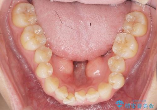 骨隆起除去とマウスピース矯正の治療前