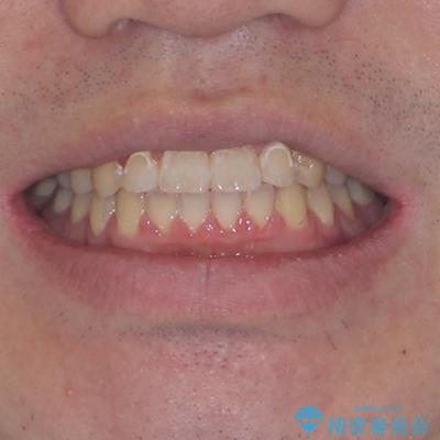 目立つ八重歯を非抜歯矯正で整える 目立たないワイヤー矯正の治療後(顔貌)