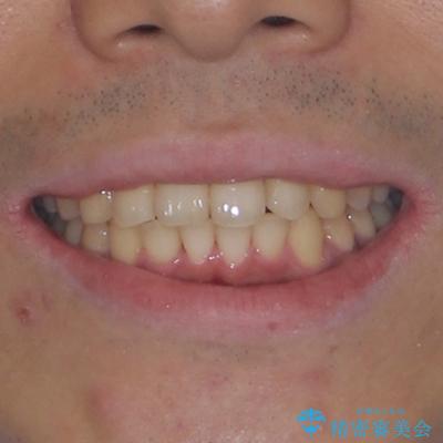 前歯のデコボコを治したい ワイヤー装置での非抜歯矯正の治療後(顔貌)