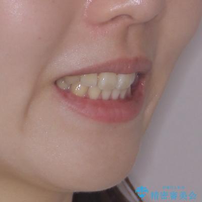 飛び出ている出っ歯を治したい 目立たない装置での抜歯矯正治療の治療後(顔貌)