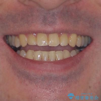 受け口を治す ワイヤー装置での矯正治療の治療後(顔貌)