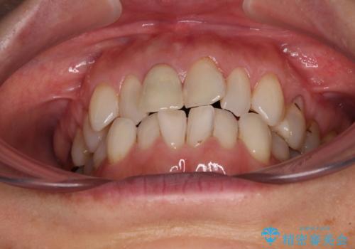 デコボコと銀歯 矯正治療とセラミック治療で綺麗な口元にの治療前