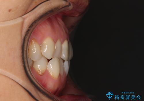 デコボコと銀歯 矯正治療とセラミック治療で綺麗な口元にの治療前
