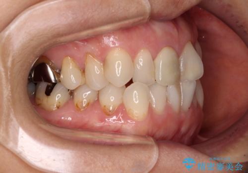 デコボコと銀歯 矯正治療とセラミック治療で綺麗な口元にの治療前