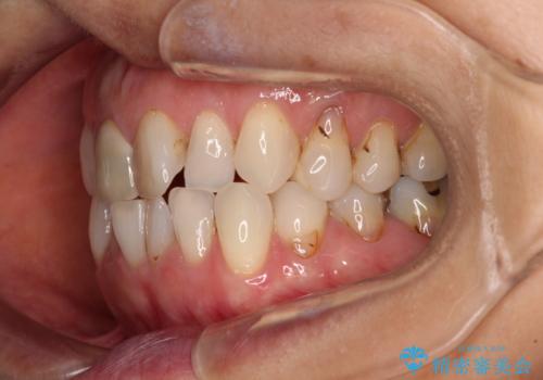 デコボコと銀歯 矯正治療とセラミック治療で綺麗な口元にの治療前