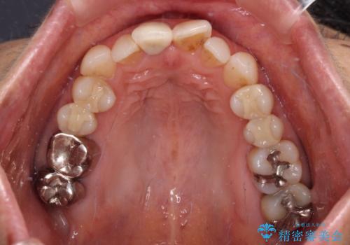 デコボコと銀歯 矯正治療とセラミック治療で綺麗な口元にの治療前