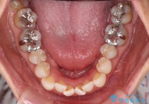 デコボコと銀歯 矯正治療とセラミック治療で綺麗な口元にの治療前