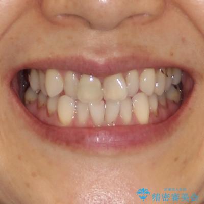 デコボコと銀歯 矯正治療とセラミック治療で綺麗な口元にの治療前(顔貌)