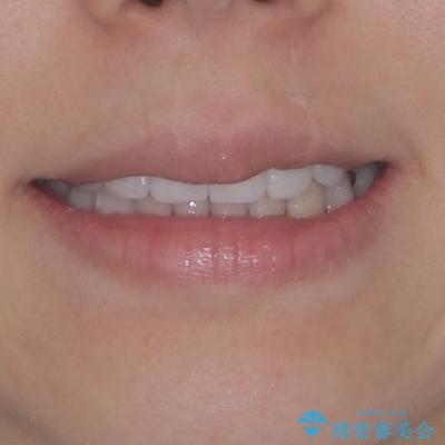 気になる八重歯と変色した前歯 抜歯矯正とセラミッククラウン治療の治療後(顔貌)