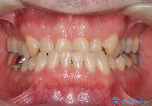 受け口を治す ワイヤー装置での矯正治療