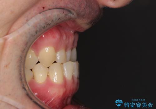 受け口を治す ワイヤー装置での矯正治療の治療前