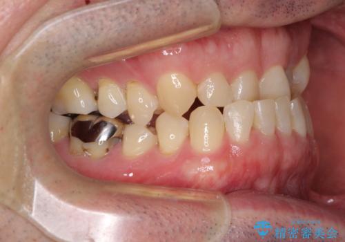 受け口を治す ワイヤー装置での矯正治療の治療前