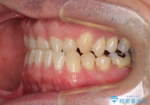 受け口を治す ワイヤー装置での矯正治療の治療前