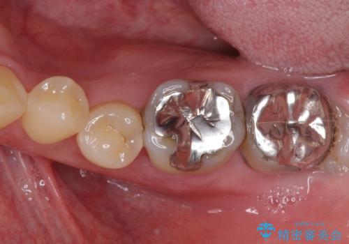 受け口を治す ワイヤー装置での矯正治療の治療前