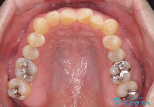 受け口を治す ワイヤー装置での矯正治療の治療前