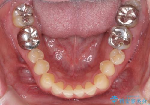 受け口を治す ワイヤー装置での矯正治療の治療前