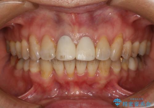 【非抜歯】加速矯正で超短期間治療!噛み合わせが劇的に改善の症例 治療後