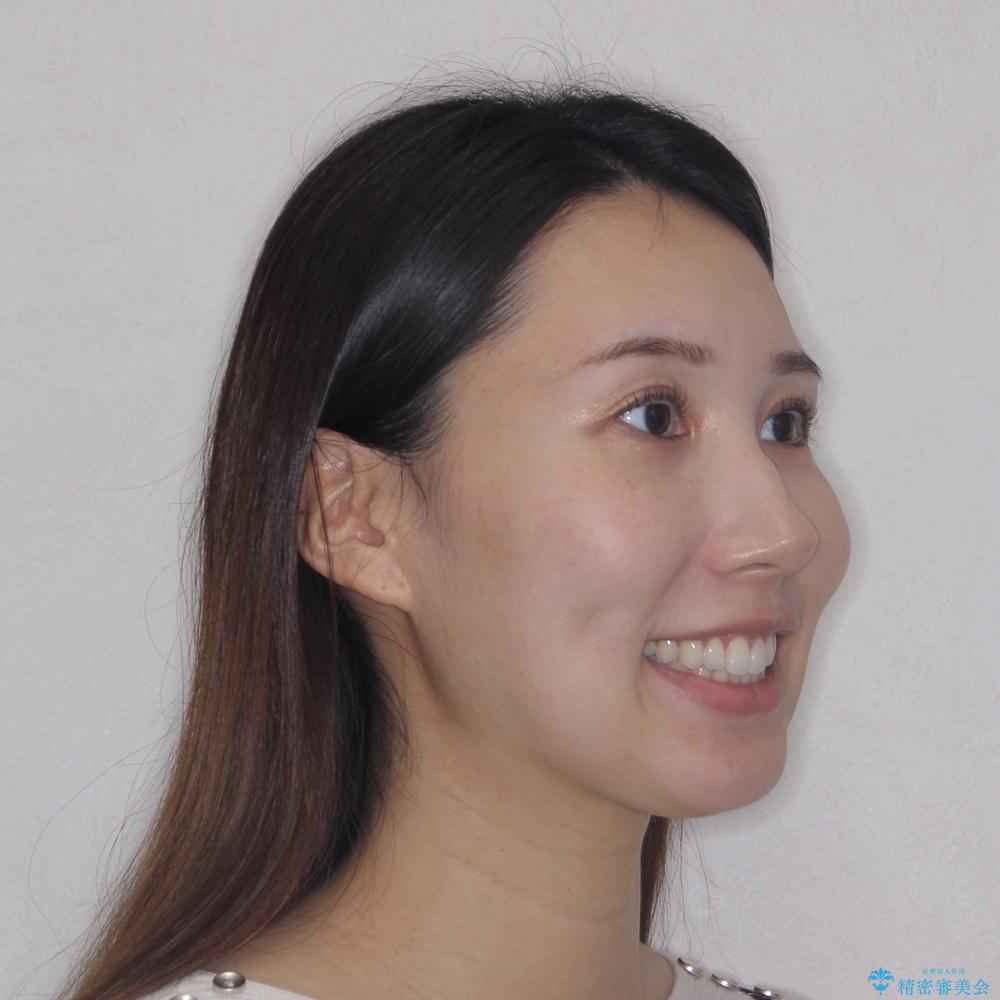 【モニター】前に傾斜した前歯 インビザラインでスッキリとした口元にの治療後(顔貌)