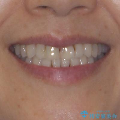 デコボコと銀歯 矯正治療とセラミック治療で綺麗な口元にの治療後(顔貌)