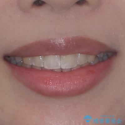前に飛び出して目立っている前歯を整える インビザライン矯正治療の治療後(顔貌)