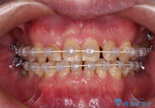 受け口を治す ワイヤー装置での矯正治療の治療中